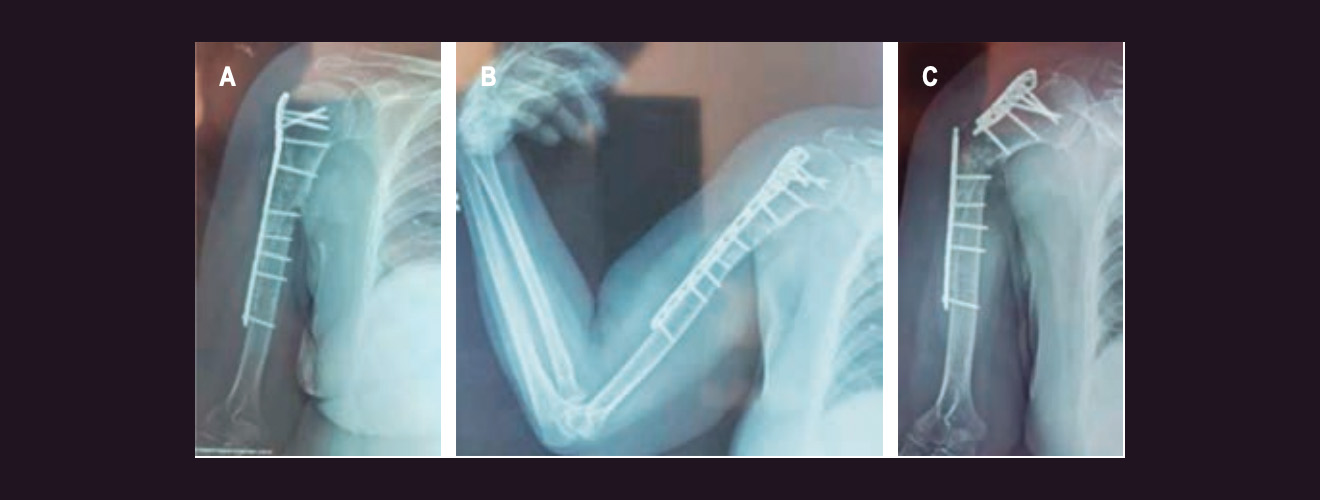 A y B) Radiografías anteroposterior y lateral tras el segundo procedimiento quirúrgico. C) Radiografía que muestra rotura de la placa a las ocho semanas postquirúrgicas