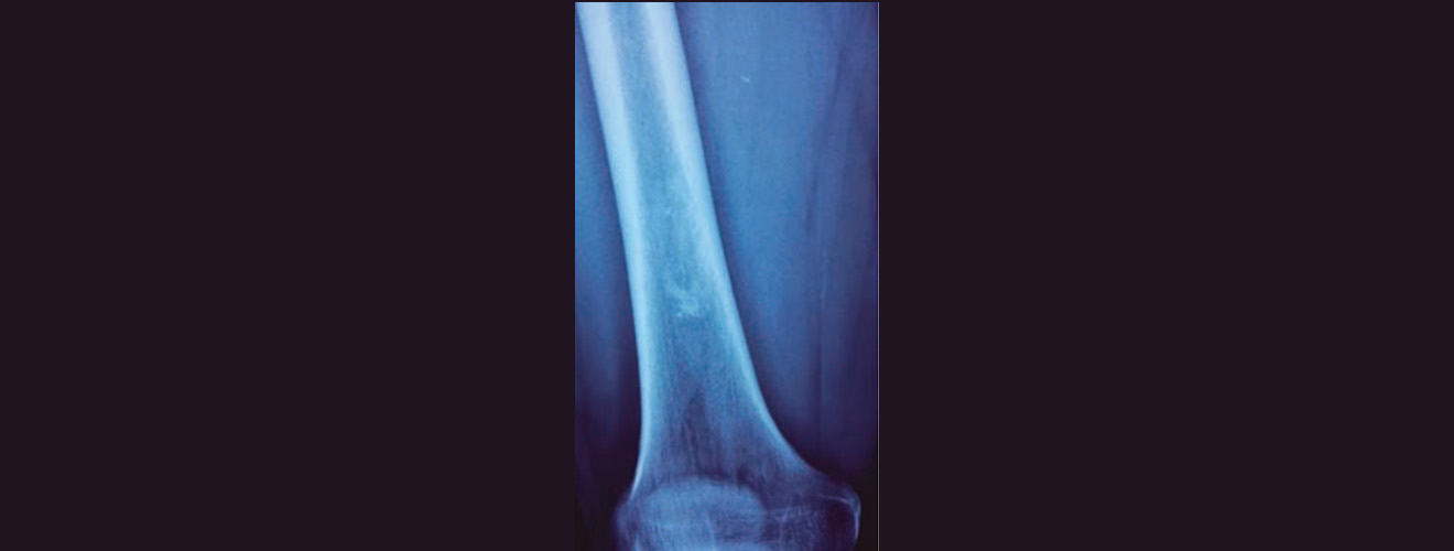 Radiografía anteroposterior de fémur derecho en la que se observa imagen radiopaca irregular, delimitada al compartimiento del tercio distal del fémur.