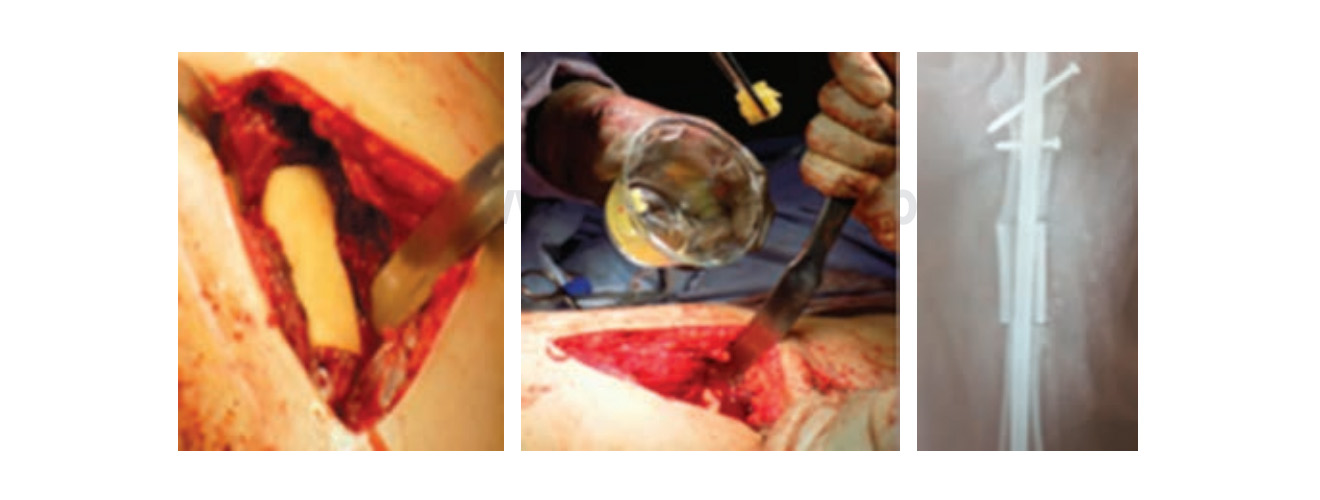 Radiografía postoperatoria, colocación de aloinjerto, plasma rico en plaquetas, chips y matriz ósea.