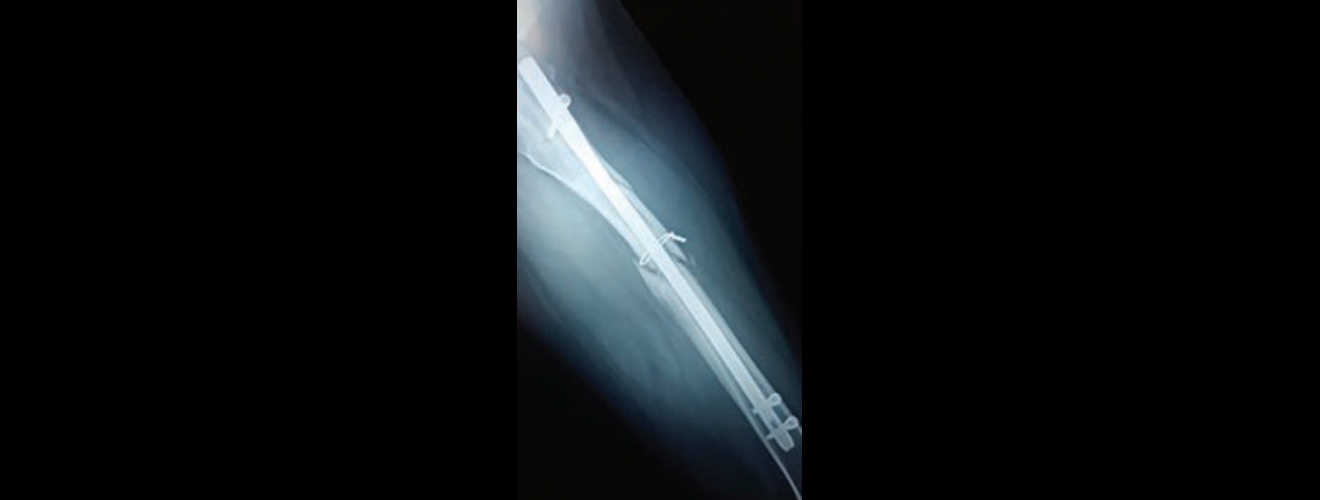 Radiografía que muestra pseudoartrosis de fémur izquierdo.