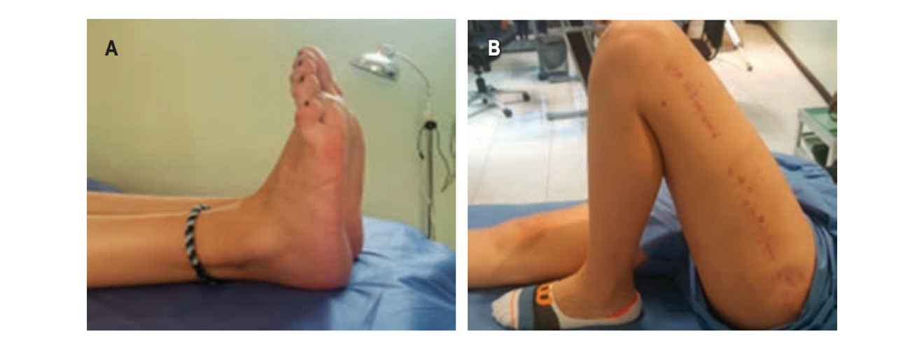 A) Recuperación de 2 cm de acortamiento inmediato. B) Exploración de arcos de movilidad dos meses del postquirúrgico.