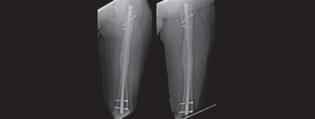 Seguimiento a cuatro años